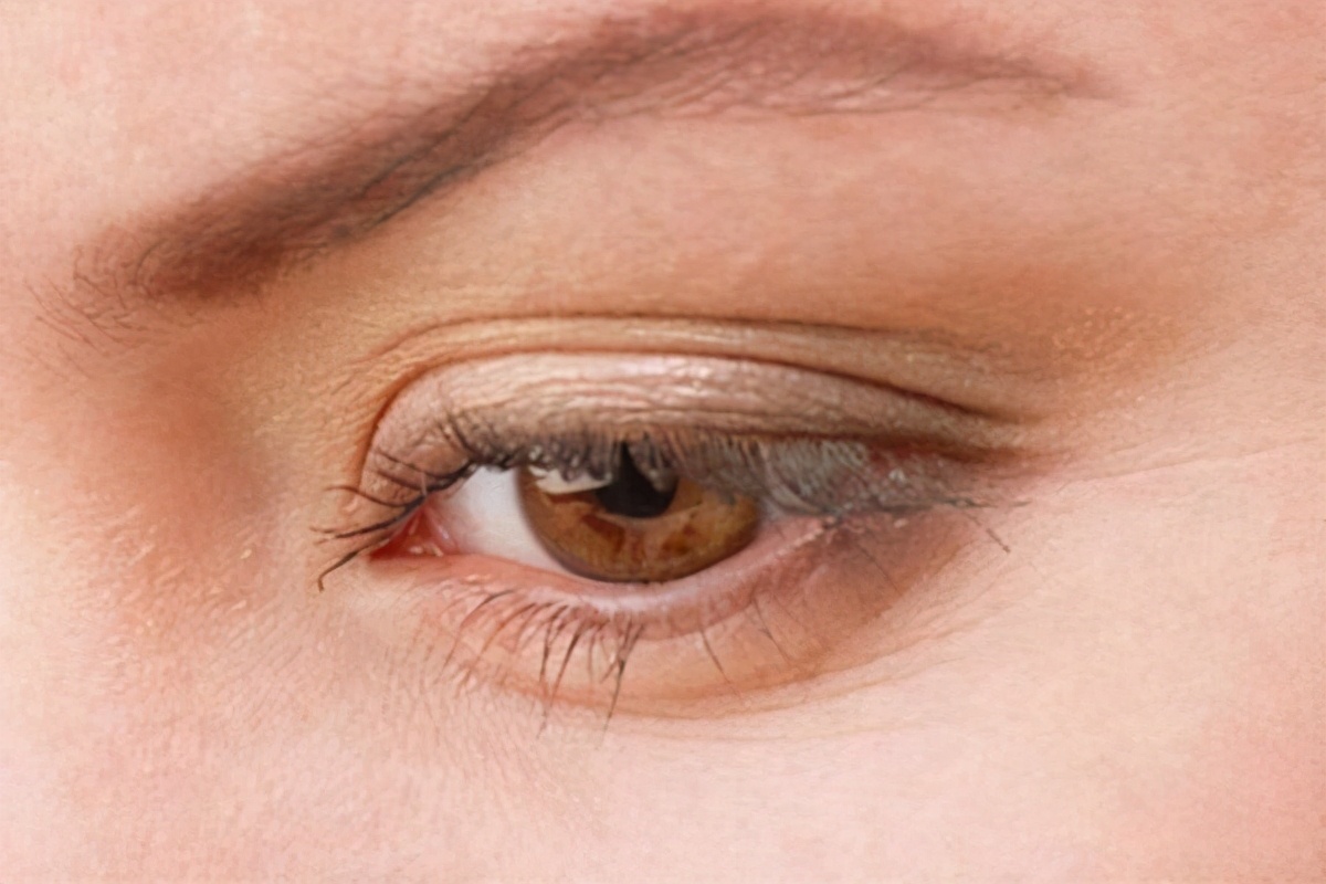 眼睛上睑回缩是什么原因,眼睛上睑下垂该怎么办