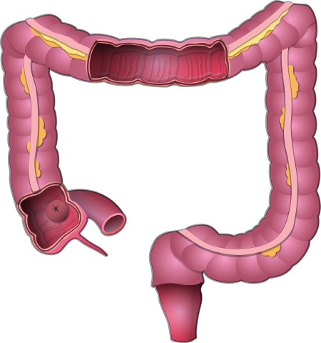 肠道健康小方法,肠道息肉一年长多少厘米