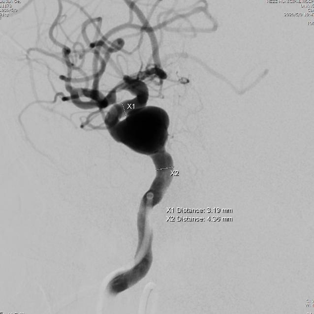 山东治脑动脉瘤最好的专家,菏泽市市立医院血管外科