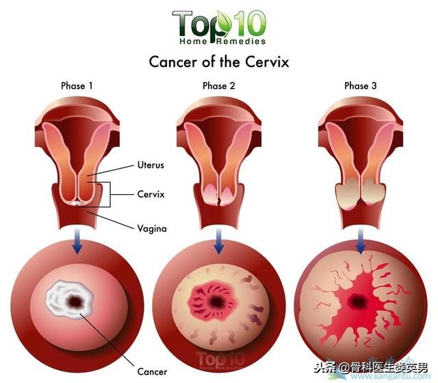得了宫颈癌别放弃,宫颈癌该如何自救