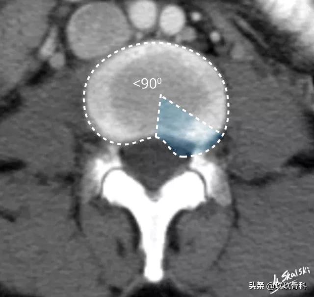 图解腰椎间盘突出,椎间盘髓核膨出图