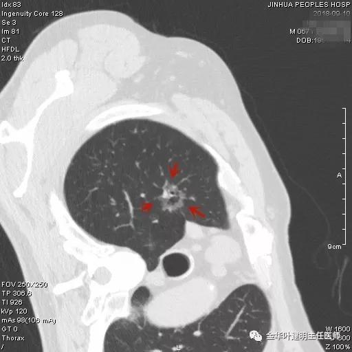 肺多发转移癌主要治疗手段,右肺上叶癌怎么治疗
