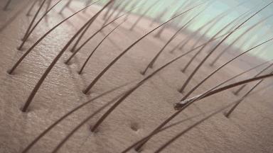 头皮毛囊炎一定要重视，不然一不小心就秃头，假发也救不了你