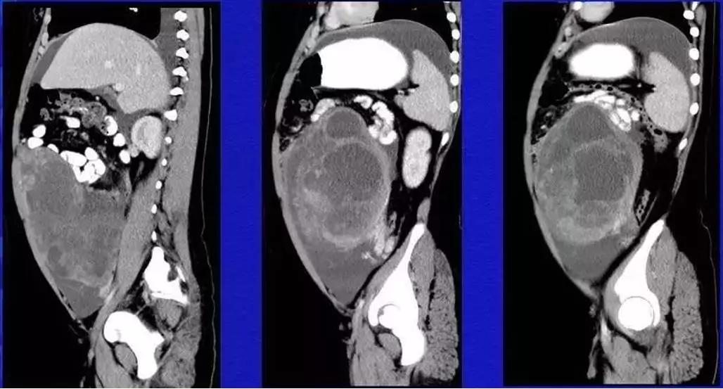 卵巢原发肿瘤的分析思路