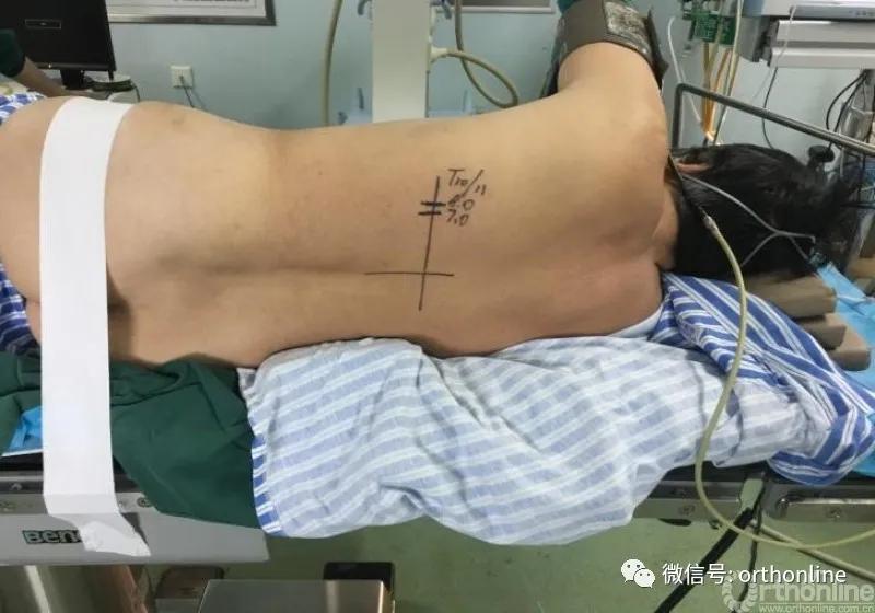 胸椎怎么做微创,脊柱内镜微创操作流程