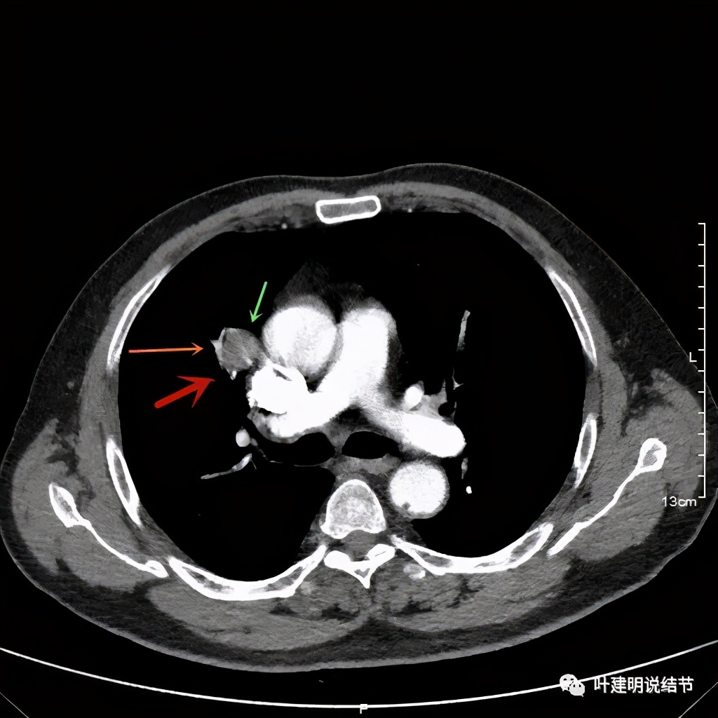 误诊报告图片,误诊案例及案例分析