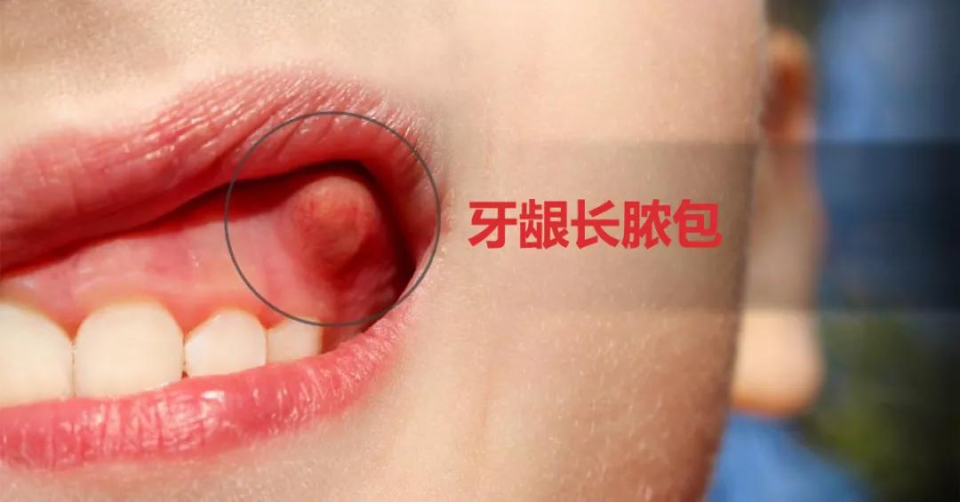 小孩子牙龈长脓包要做根管治疗吗,根管治疗两年后牙龈长脓包怎么办
