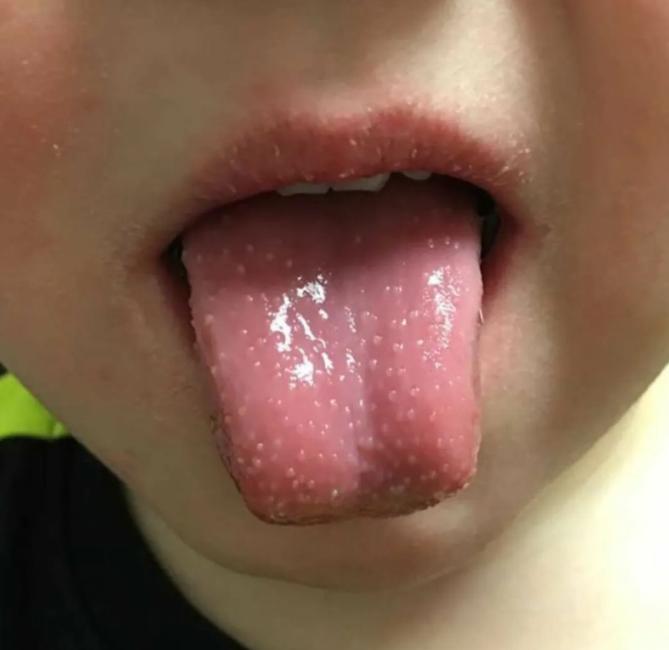 哪些国家有儿童感染新冠病毒的,现在新冠病毒儿童最新症状