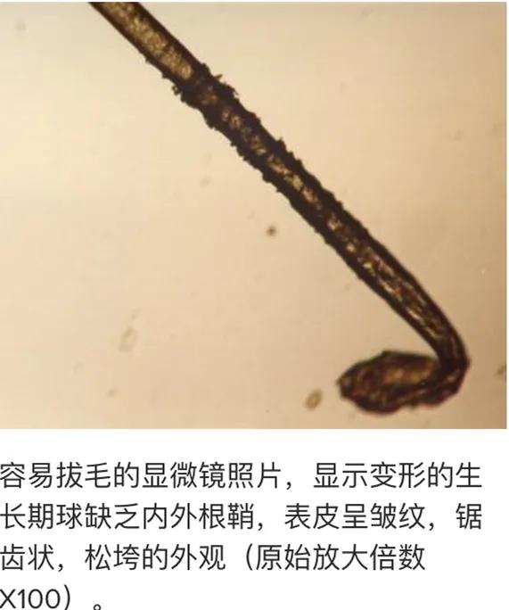 儿童脱发会是什么病的前兆,孩子毛囊引起的脱发怎么办