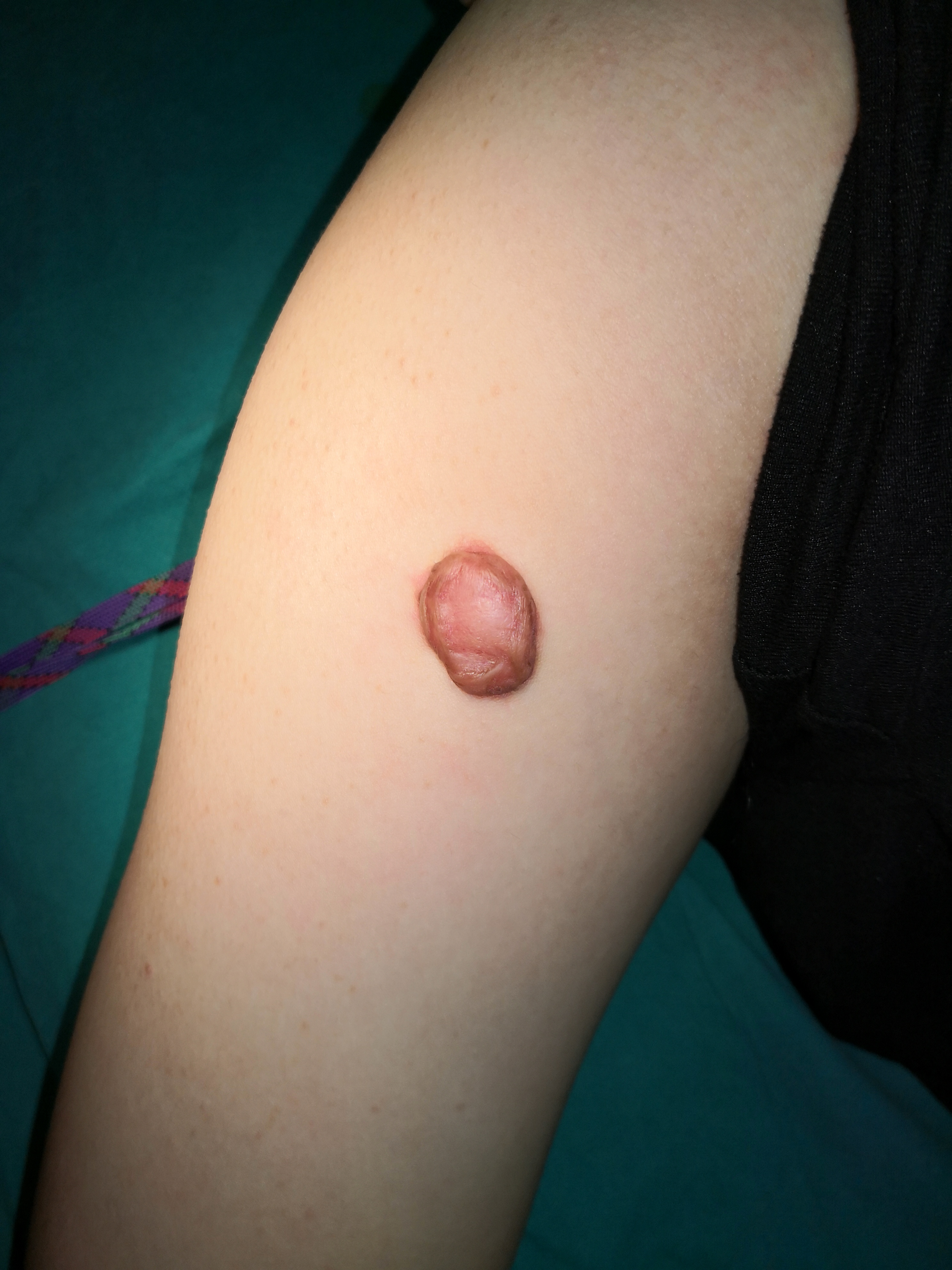 疤痕疙瘩切除后又复发怎么办,增生疤痕疙瘩切除复发率高吗