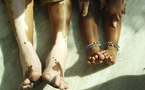 长了白斑怎么治疗,脚上长白斑是怎么回事