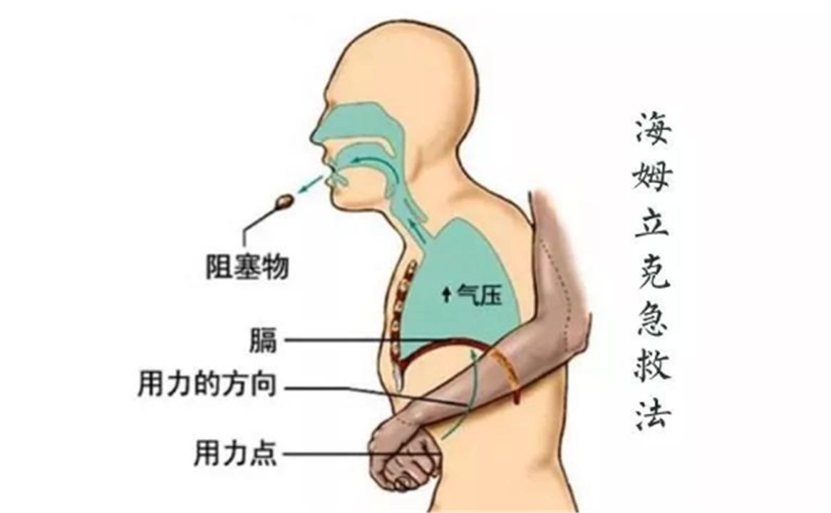 小孩异物卡喉急救方法,孩子异物卡喉急救后未排出没事吗