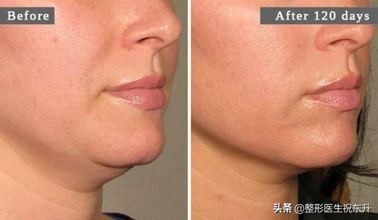 法令纹医院可以去除吗,法令纹能靠药膏解决吗