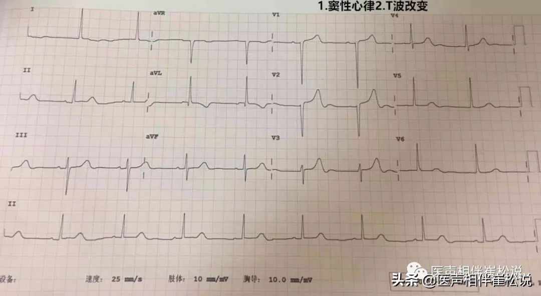 心电图上t波改变啥意思,心电图上t波改变