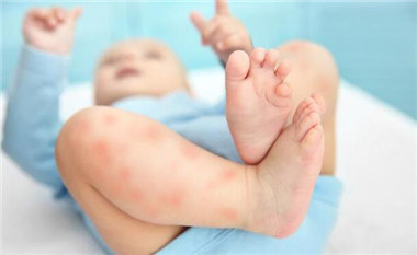 湿疹5个护理方法大家一起看一看,三个月大宝宝湿疹严重怎么护理