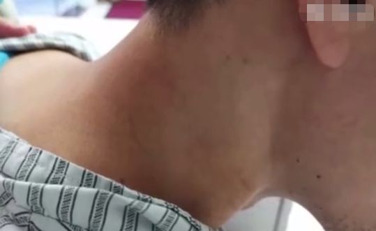 小伙出现头痛等症状,医生:因为做刮痧推拿引发了脑梗