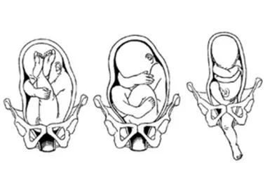 臀位外倒转术一般多少周做,孕妇臀位外倒转术视频