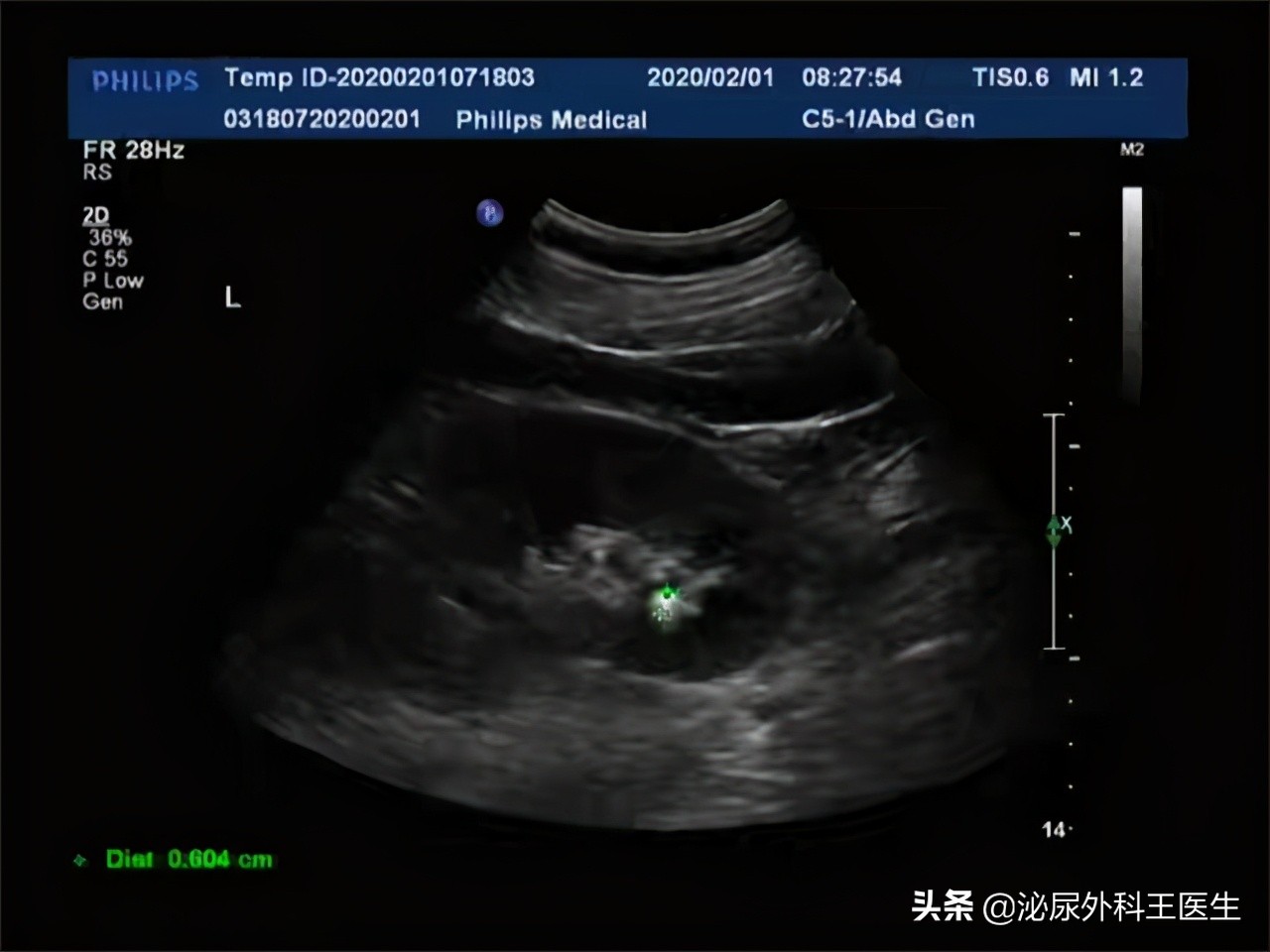 排石颗粒真的可以使结石变小吗,结石通和排石颗粒哪个效果更好