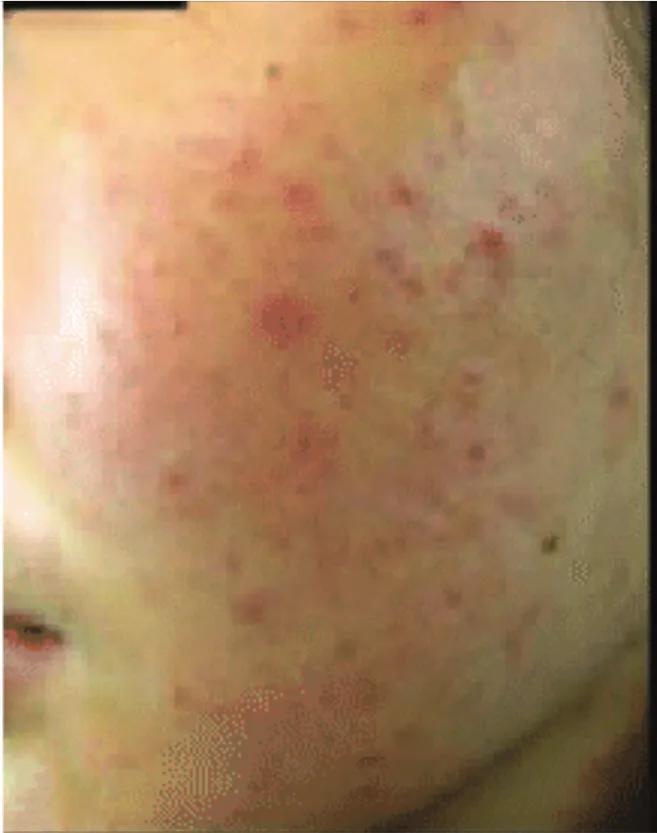 疮好后有红色疤痕怎么消除,长疮留下的黑色素沉着怎么去掉