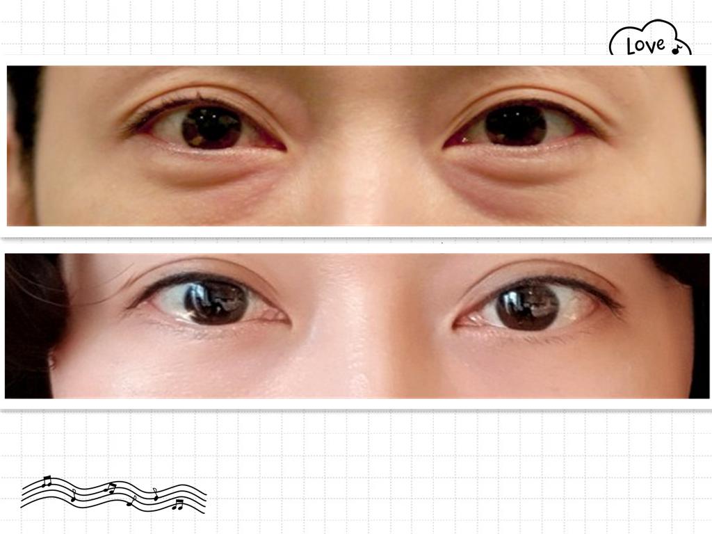 祛眼袋是怎么祛的,有效祛眼袋感受