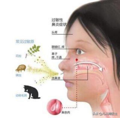 春天鼻炎哮喘是什么原因,春天鼻炎犯了该怎么治疗