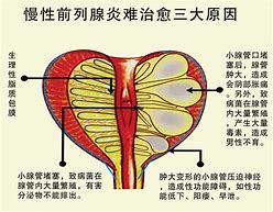 针灸能治前列腺炎吗,站桩能治前列腺炎吗