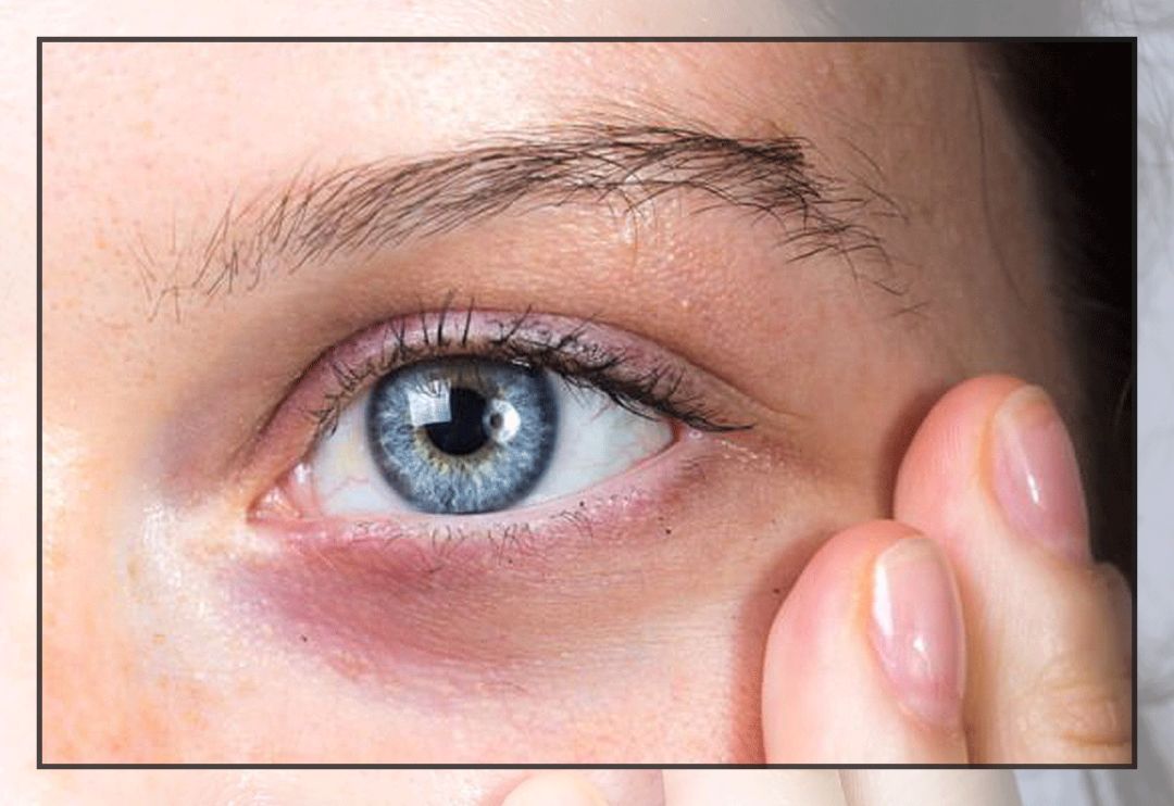 花了10800块去黑眼圈没效果,网上治疗黑眼圈靠谱么