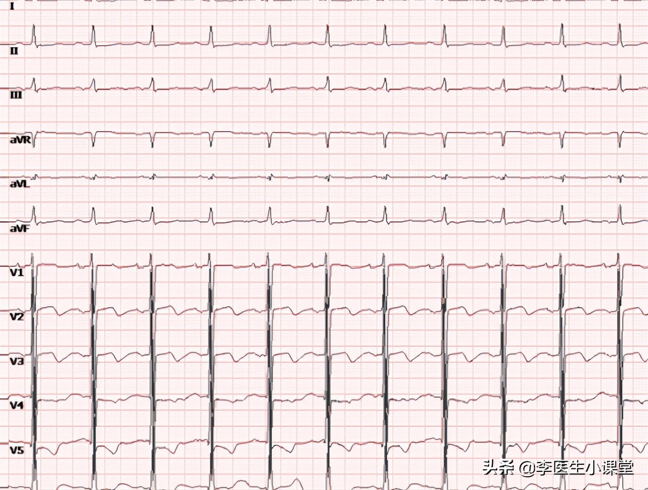 夏季天热出汗多应该喝什么汤,天热出汗多吃啥能补充钾