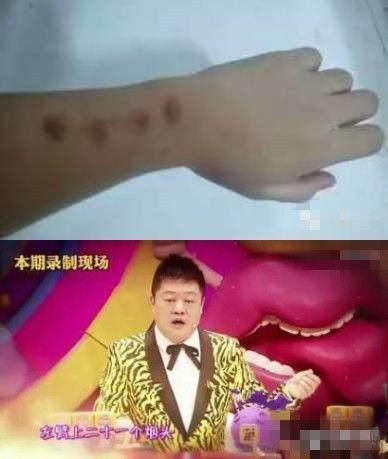 高晓松烟疤,高晓松手臂的烟疤