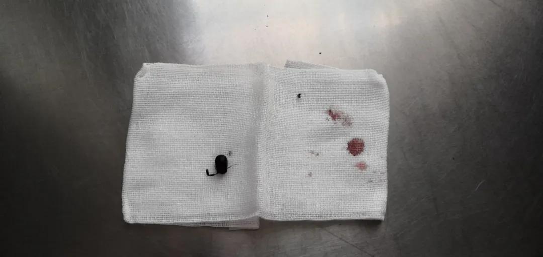 西安一幼童遇“飞虫入耳”，医生：千万别掏！可用这种东西