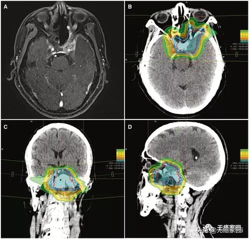 鼻咽癌复发的治愈率高吗,质子重离子治疗鼻咽癌3期