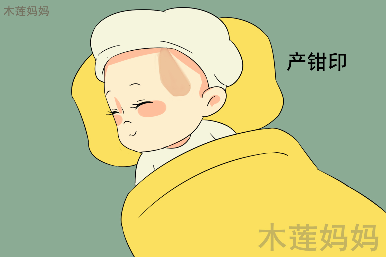 产钳在宝宝的脸上留下疤痕了,不小心给宝宝留下产钳印