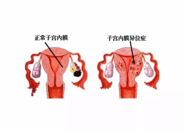 女人痛经是否和本身生理结构有关,痛经是一种心理障碍吗