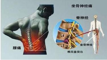 腰椎间盘突出脚肌肉萎缩怎么恢复,腰椎间盘突出会导致腿部肌肉萎缩