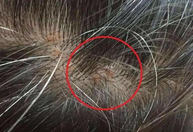 怎样去除头屑中的头皮屑,头皮屑多怎么办9个方法告别头屑