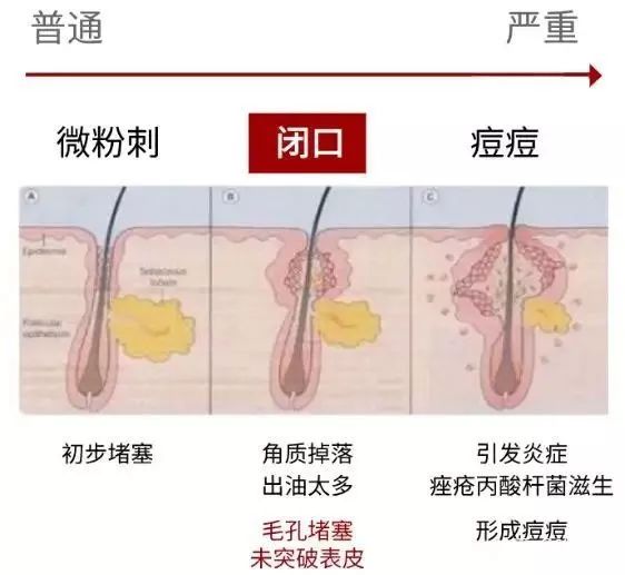 脸部黑头粉刺有必要去美容院挤吗,粉刺黑头应不应该挤掉