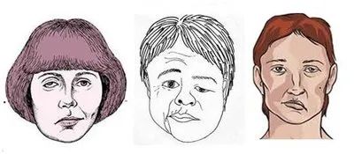 面肌痉挛手术后3年眼皮跳,长时间下眼皮抽搐痉挛怎么治