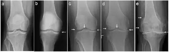 怎么区分关节炎滑膜炎骨质增生,膝关节滑膜炎和骨质增生区别