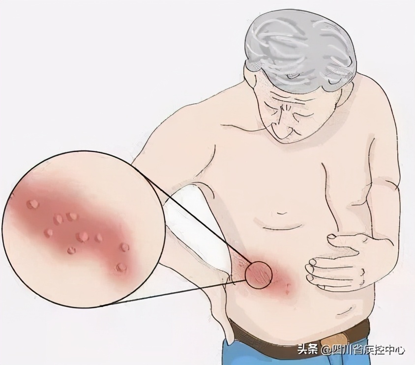 拿什么拯救你，连呼吸都痛的带状疱疹？