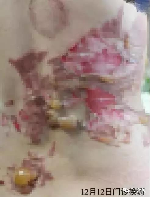 拔火罐烧伤的明星,明星拔火罐烧伤