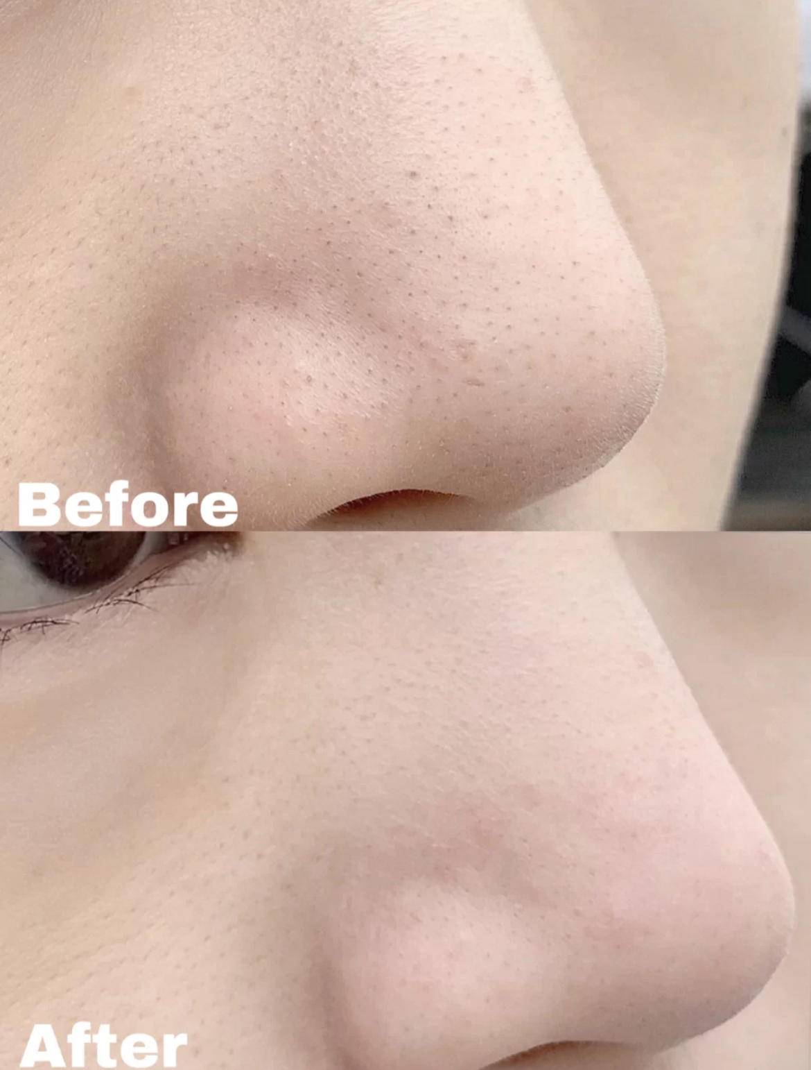 混合性肌肤t区出油怎么办,混合皮肤t区出油是什么原因