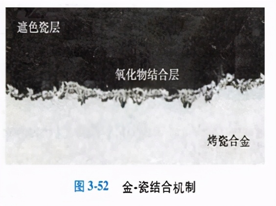 口腔金属冠与全瓷冠的区别,牙科医生讲义