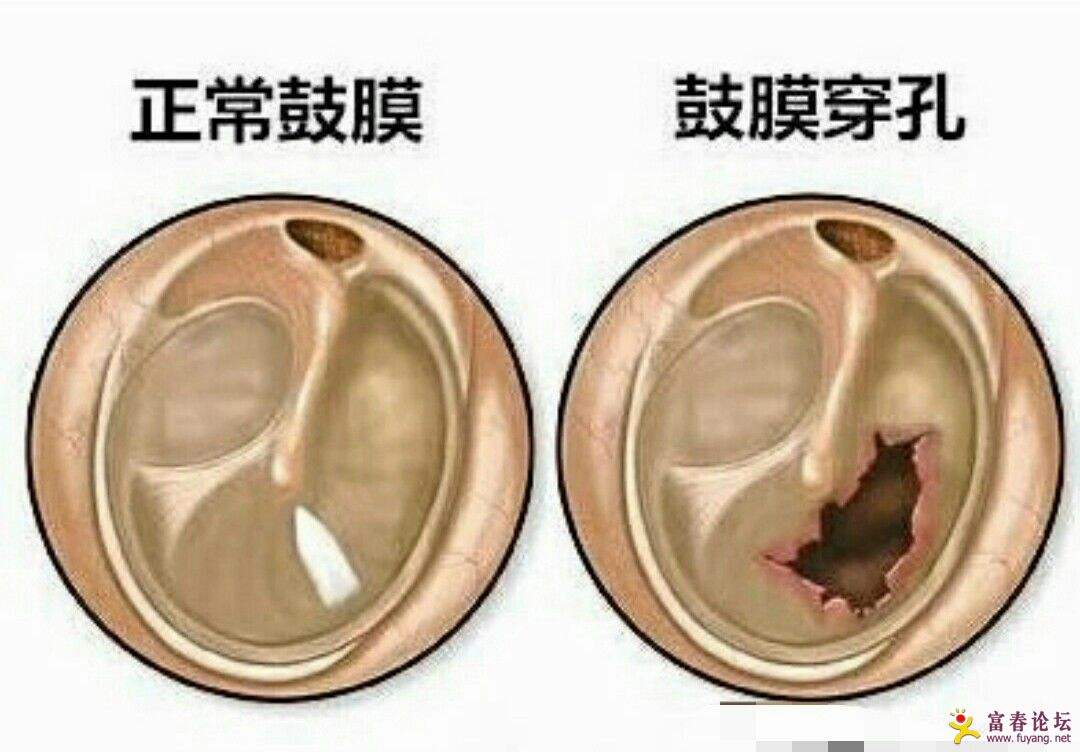 耳屎堵得很厉害需要掏出来吗,耳朵深处的耳屎有必要全掏干净吗