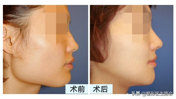 下颌角大瘦脸前后对比,下颌角宽的脸方怎么达到视觉效果
