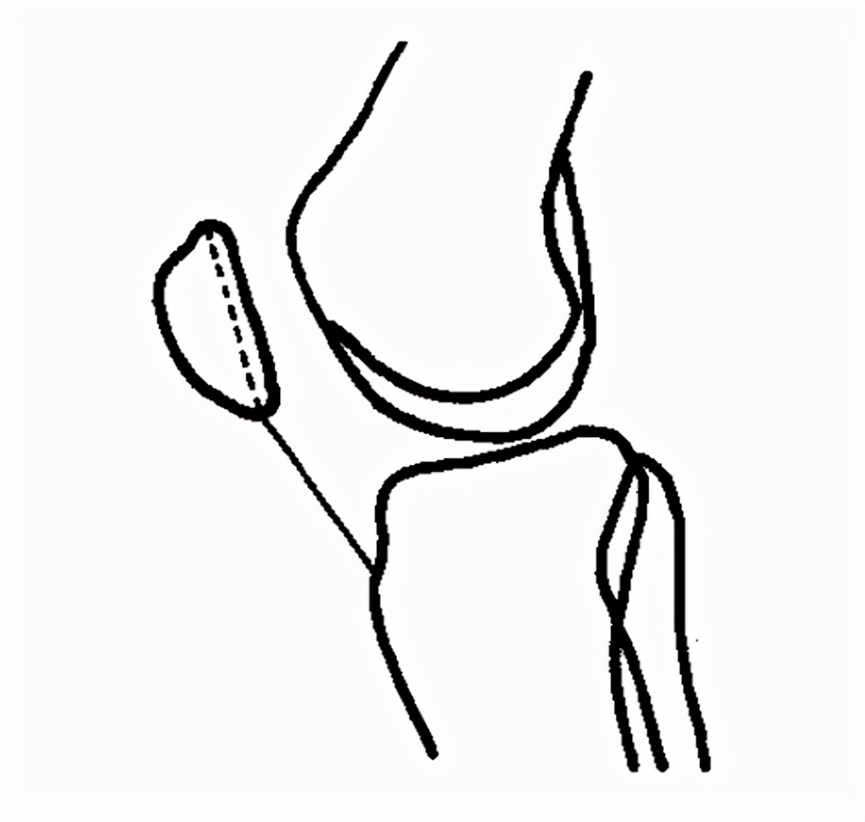 膝关节x线片可以查出啥,膝关节间隙x线测量方法