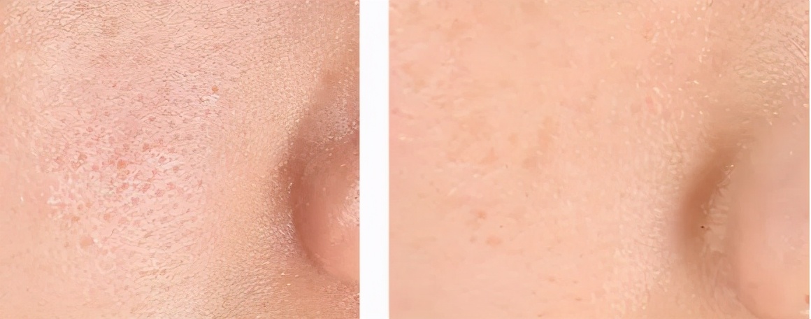 鹤叔去鼻子黑头方法,鹤叔治黑头毛孔粗大的方法原视频