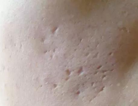 祛痘和祛痘印的方法一样吗,祛痘和祛痘印最好的方法是什么