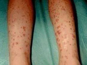 过敏性紫癜用药多久后症状能缓解,儿童过敏性紫癜的症状什么引起的