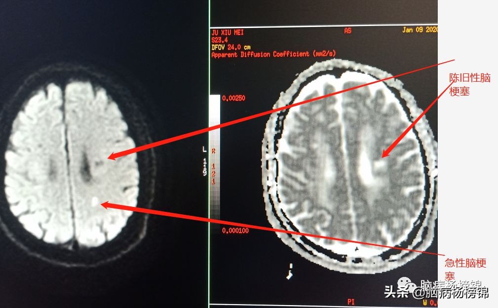 脑出血和脑梗塞同时出现已经昏迷,急性脑梗塞和急性脑出血同时出现