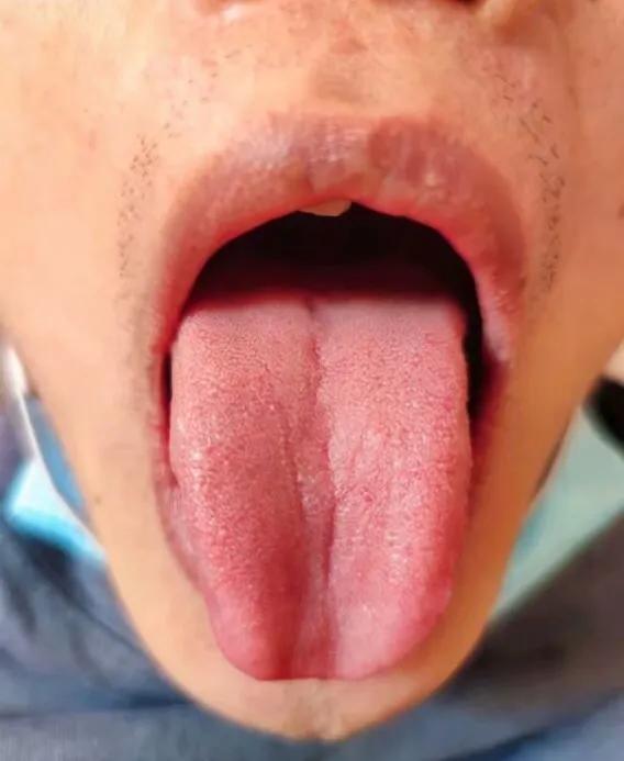 舌诊图解与针灸治疗,古法针灸点穴大全视频